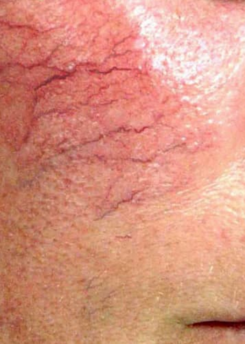 Close of an area of skin with visible thread veins