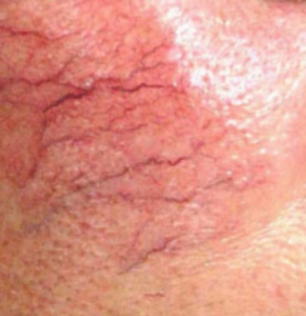 A close up of thread veins on an area of skin