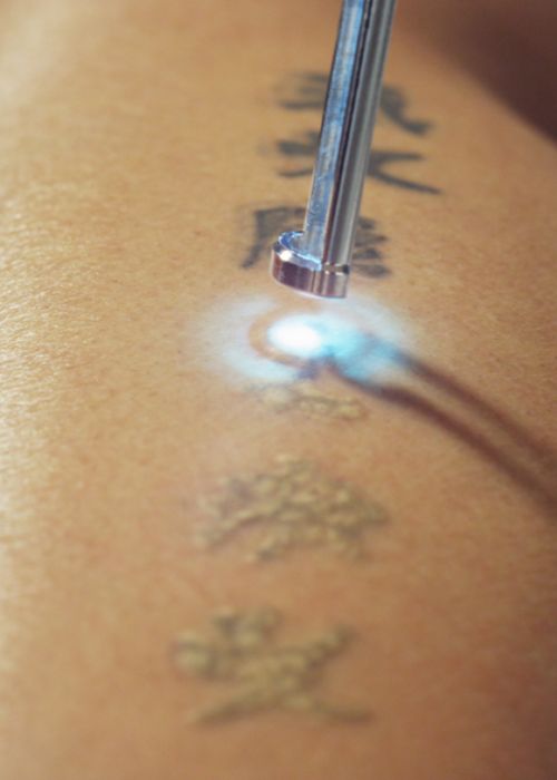 Close up of a tattoo removal in process. The treated area can be seen in the foreground